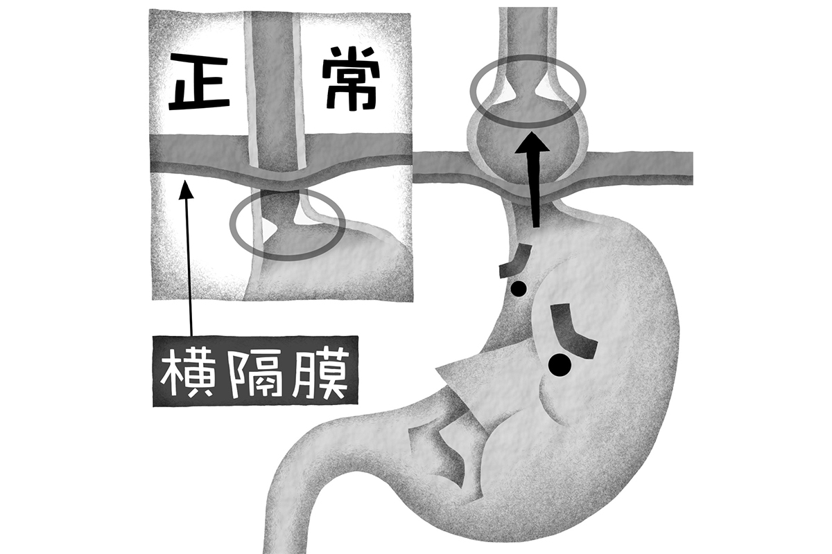 胃が胸部に出る「食道裂孔ヘルニア」は腹壁固定で再発を防ぐ｜NEWS